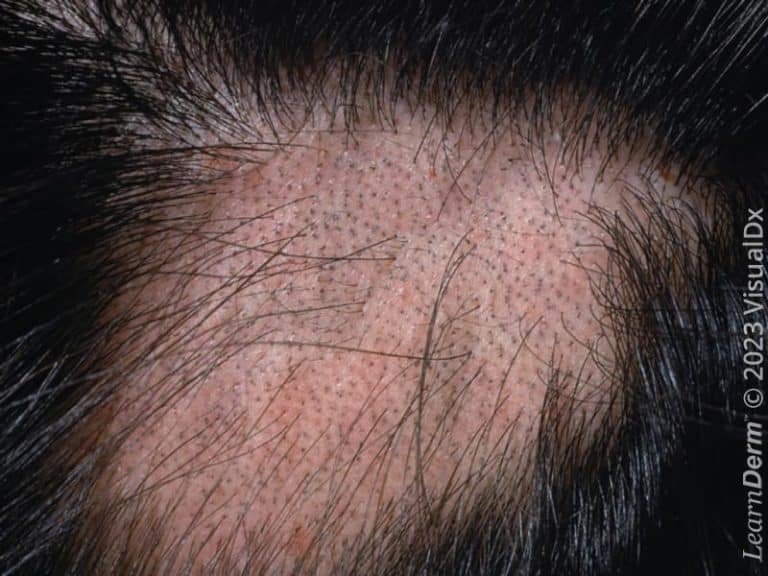 Alopecia areata