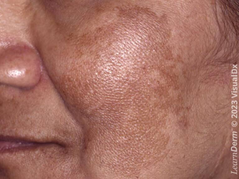 Irregular pigmented patch of melasma.