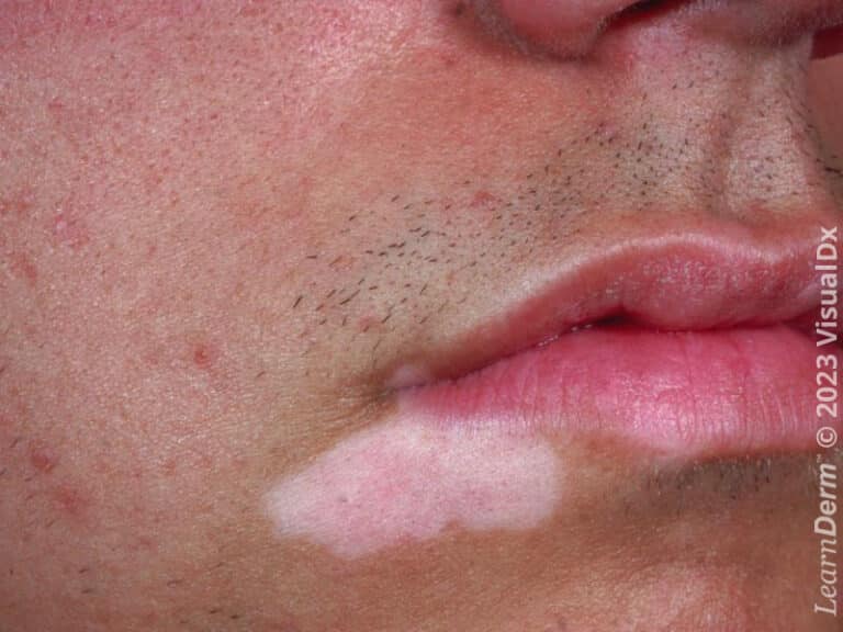 Sharply demarcated hypopigmented patch of vitiligo.