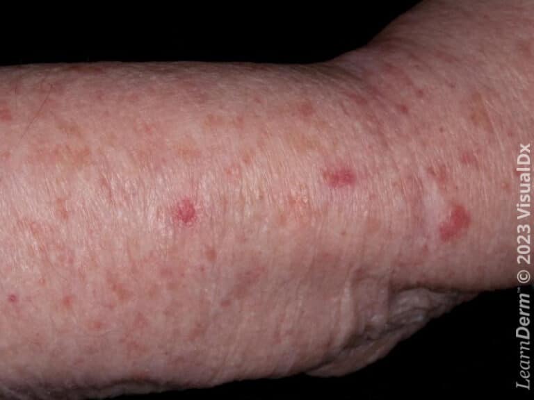 Actinic keratosis