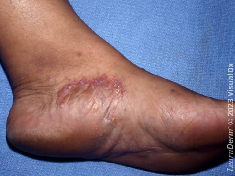 Tinea pedis