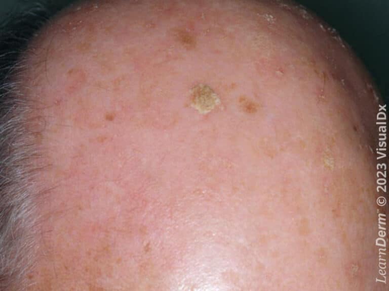 Actinic keratosis