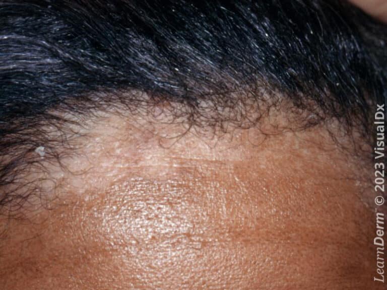 Seborrheic dermatitis