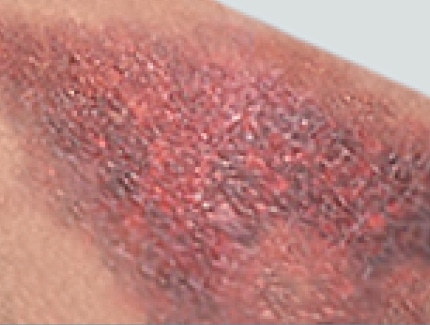 Ecchymosis