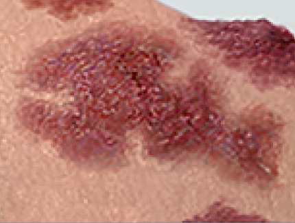 Palpable Purpura