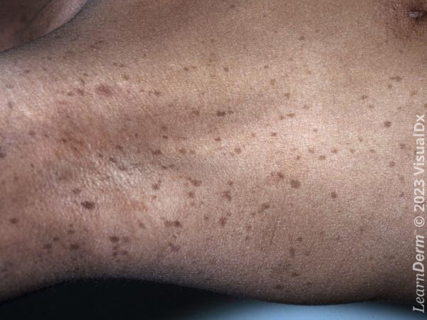 Axillary freckling in neurofibromatosis.