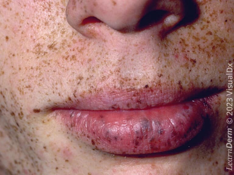 Myriad light brown hyperpigmented macules in Peutz-Jeghers syndrome.