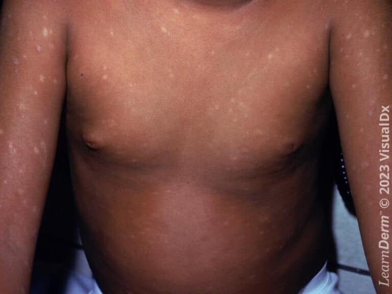 Postinflammatory hypopigmented macules in pityriasis lichenoides et varioliformis acuta.