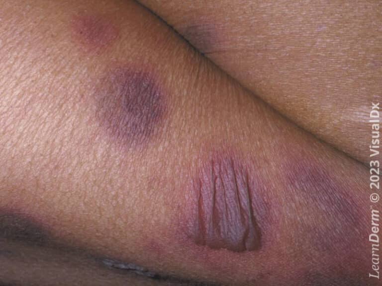 Round flaccid bullae and patches of fixed drug eruption.
