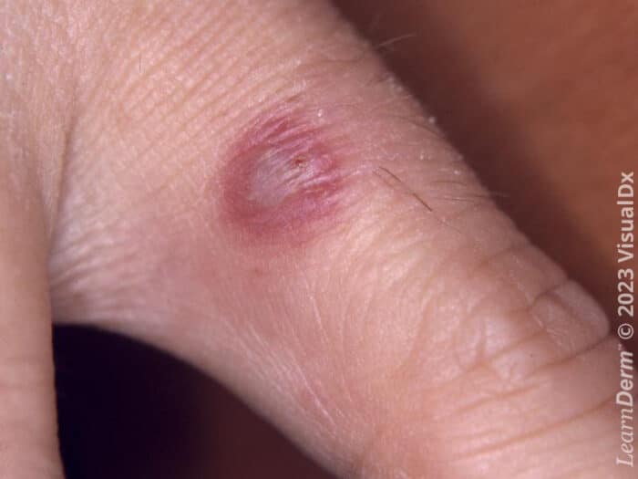 Bulla - LearnDerm