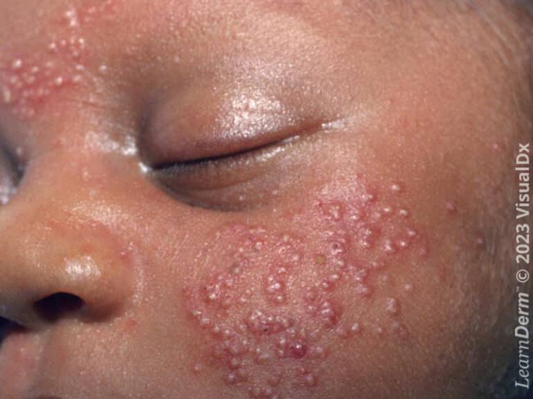 Pústulas numerosas da acne neonatal agrupadas na bochecha e na região inferior da testa.