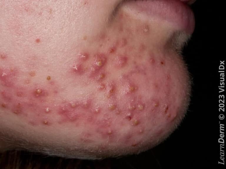 Severe pustular acne in an adolescent.