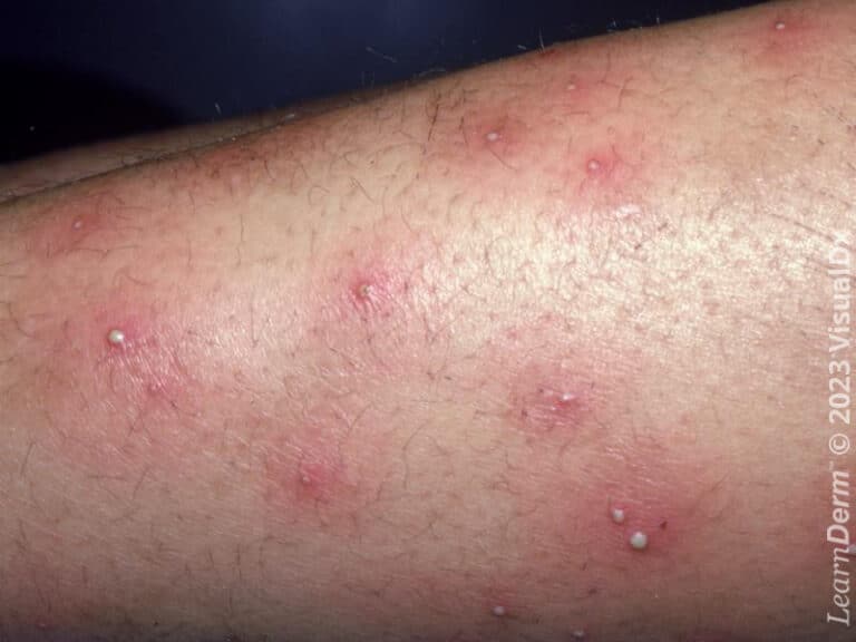 Pequeñas pústulas con eritema circundante de la foliculitis.