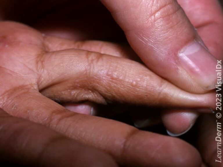 Vesículas de aspecto semelhante à tapioca de eczema desidrótico na lateral do dedo.