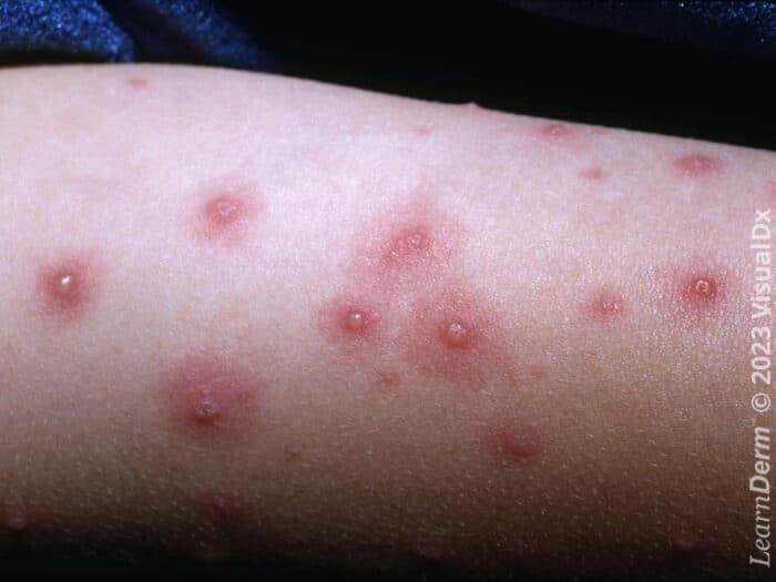 Linear Vesicles Vesicle - LearnDerm