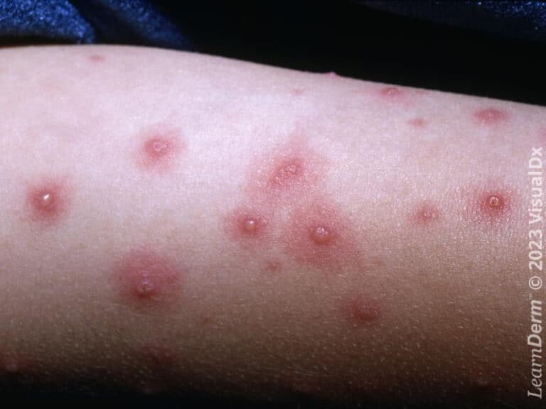 Vesicles with surrounding erythema in varicella (chickenpox).