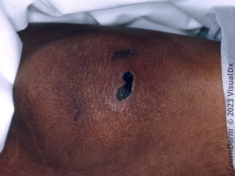 An eschar and some thinner crusts of vasculitis on a base of erythema on the knee.