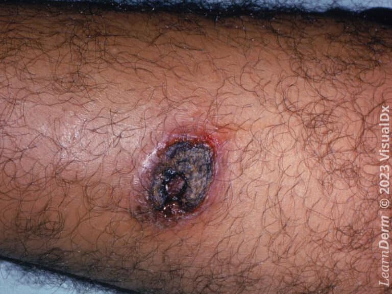 An ulcerated plaque of cutaneous leishmaniasis with an overlying eschar on the leg.