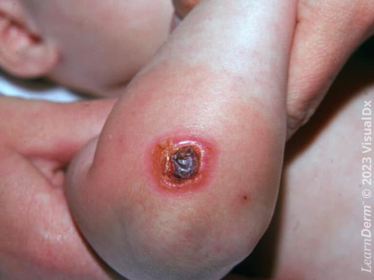 Eschar in a purpuric plaque in a child with acute meningococcemia.