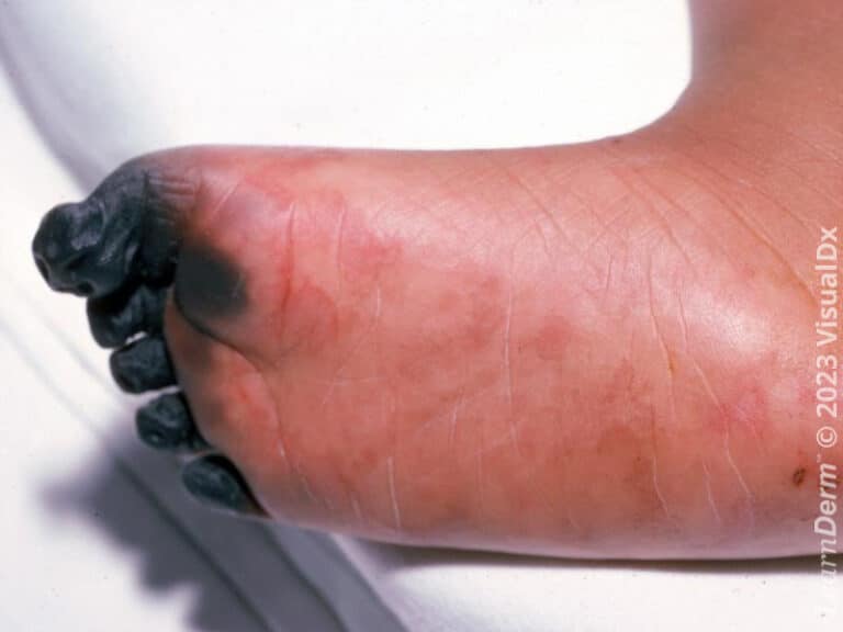 Necrotic gangrenous toes in a patient with bacterial sepsis.