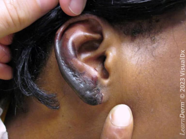 Gangrenous ear secondary to cocaine levamisole toxicity.