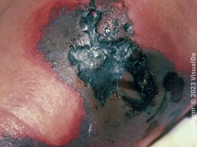 Palpable purpura and gangrene in Coumadin necrosis.