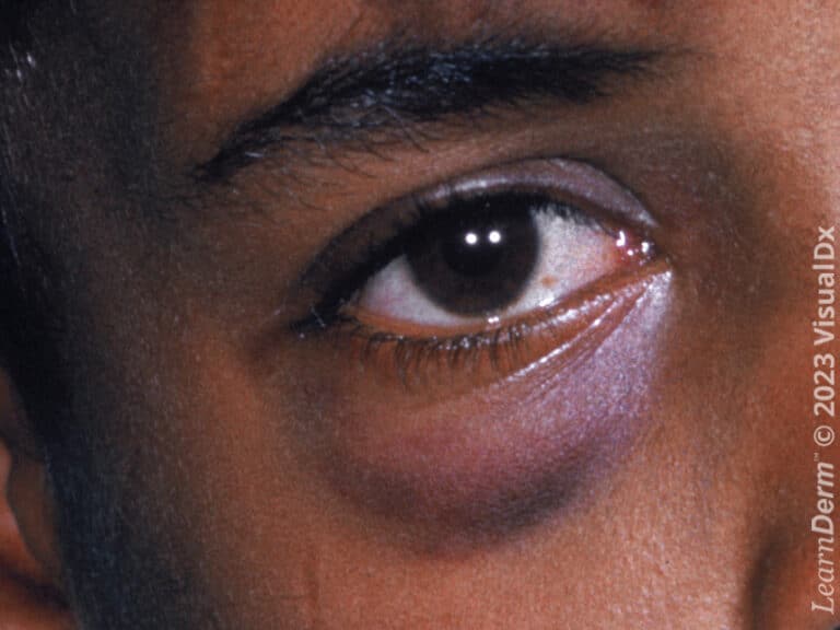 A periorbital ecchymosis appearing violaceous and greenish.