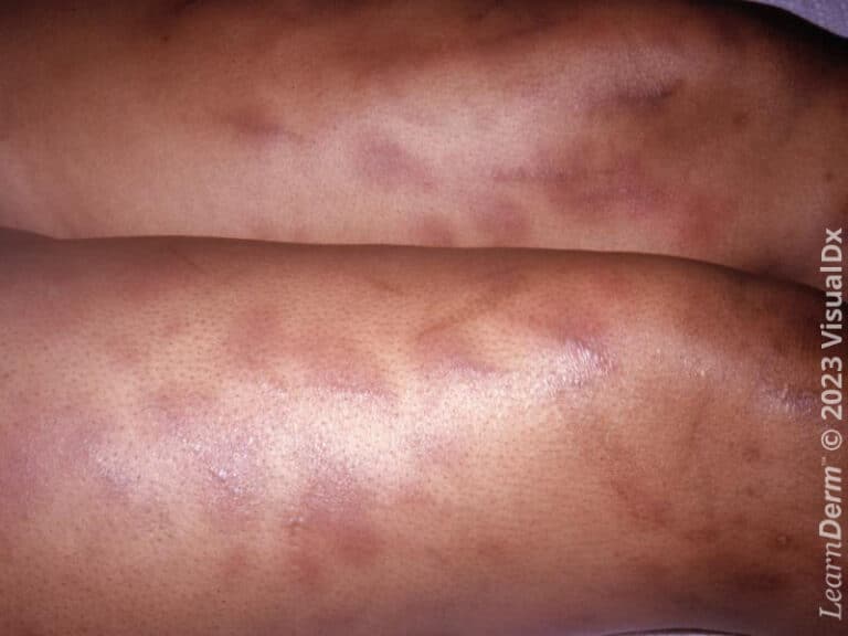 Ecchymoses in a patient with bacterial sepsis.