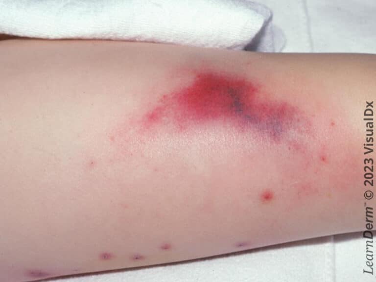 Ecchymosis in a patient with purpura fulminans.