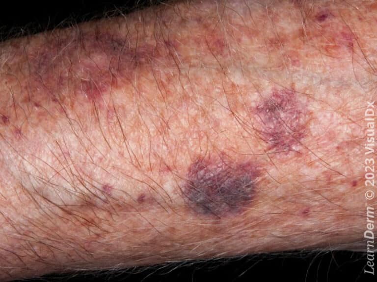 Violaceous ecchymoses on the forearm in solar purpura.