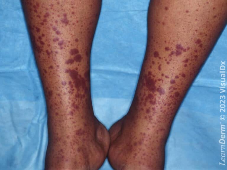 Múltiples pápulas y placas purpúricas de vasculitis por IgA en las piernas.