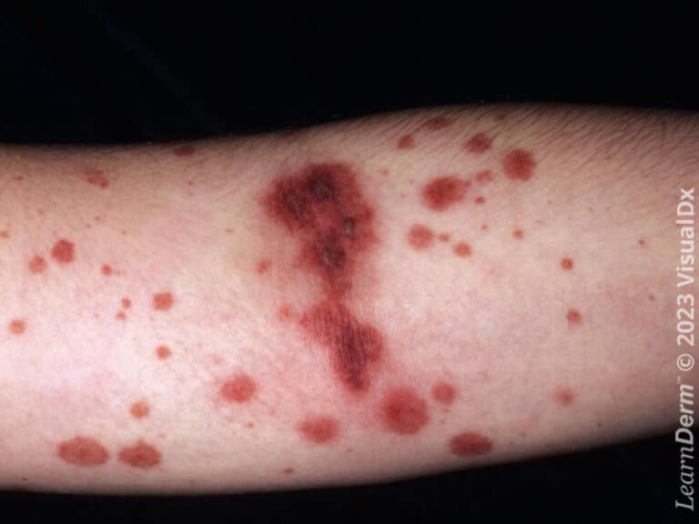 Pápulas y placas purpúricas causadas por vasculitis en la púrpura de Henoch-Schönlein.