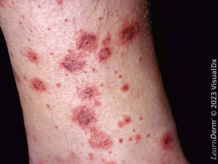 Palpable purpura of vasculitis.