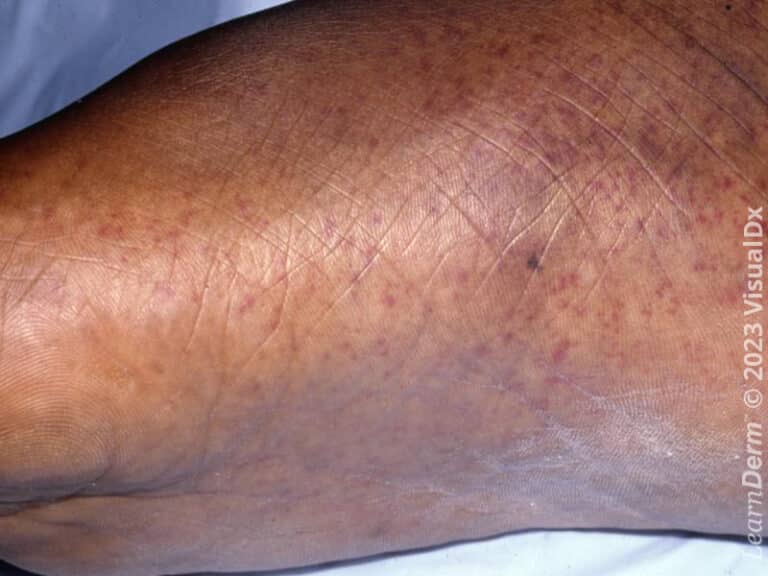 Petechiae on the plantar foot in subacute bacterial endocarditis.