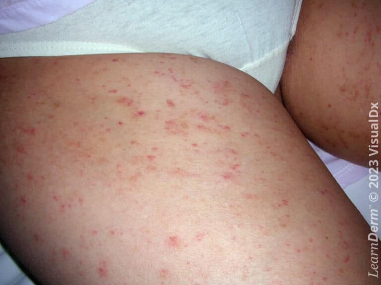 Petechiae in strongyloidiasis.