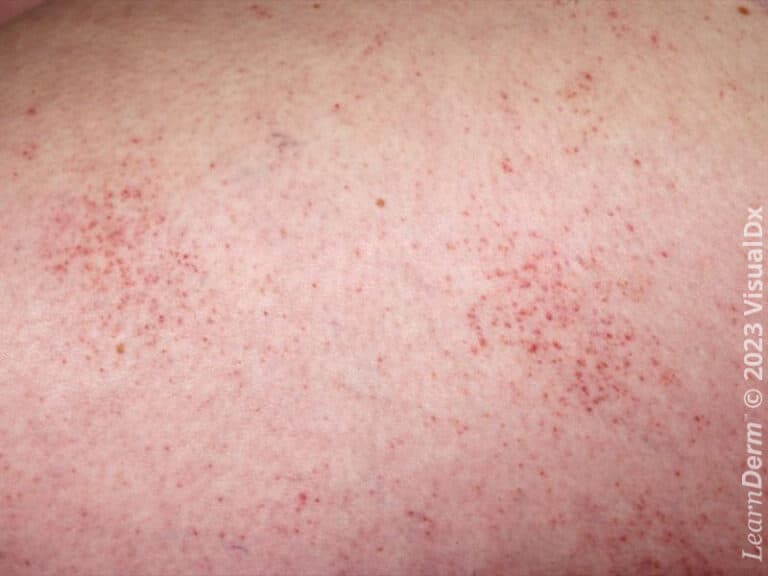 Petechiae in viral exanthem.