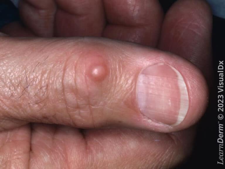 Myxoid cyst on the thumb.