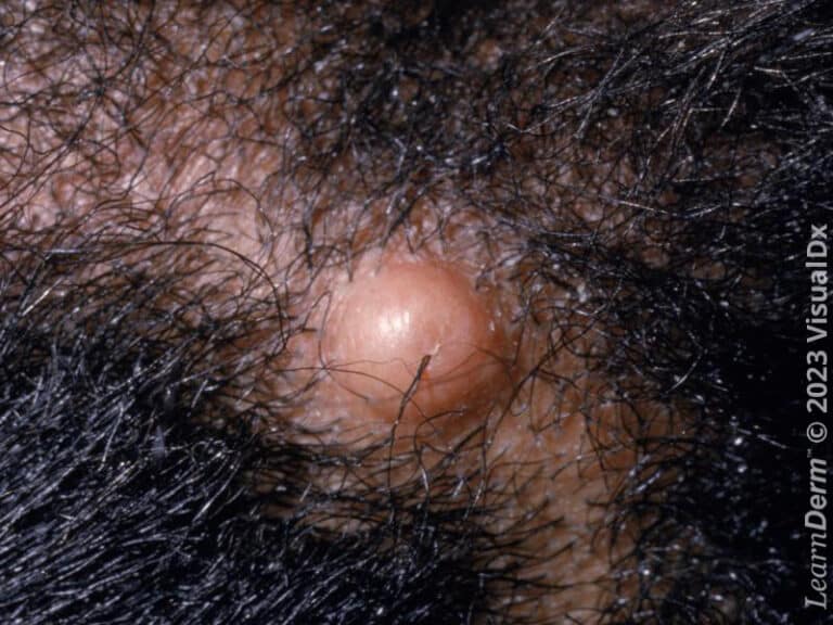 Pilar cyst of the scalp.