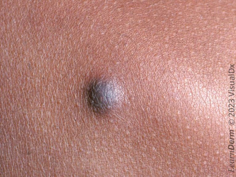 Nódulo firme hiperpigmentado único: dermatofibroma