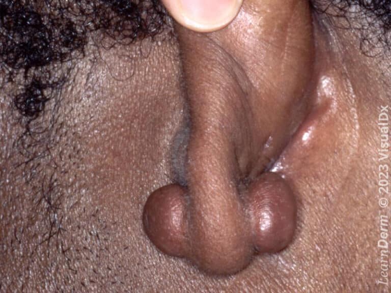Keloidal nodules on the earlobe
