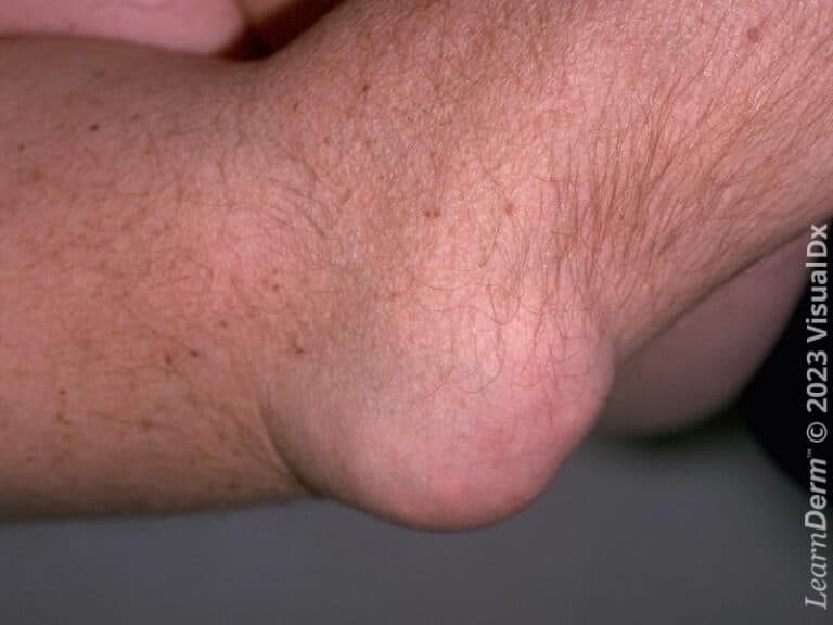Large subcutaneous hard nodule of gout