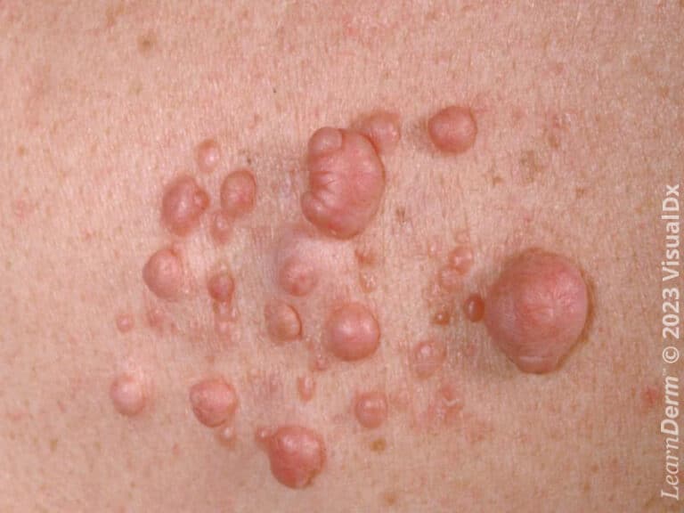 A single hyperpigmented firm nodule of dermatofibroma.