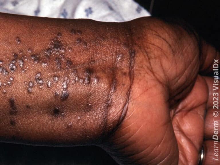 Papules aplaties caractéristiques sur la face palmaire du poignet dans le lichen plan