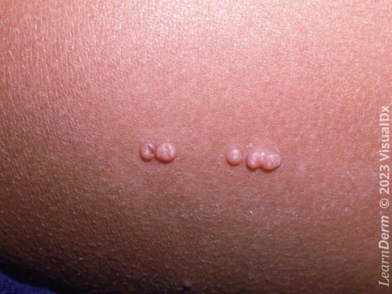 Smooth papules of molluscum contagiosum in a linear distribution.