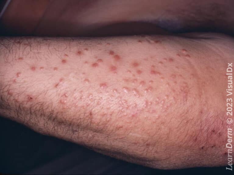 Firm, smooth papules of eruptive xanthoma.