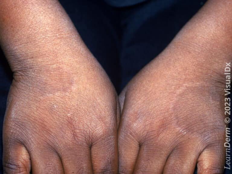 Smooth annular and arcuate plaques of granuloma annulare on the dorsal hands.