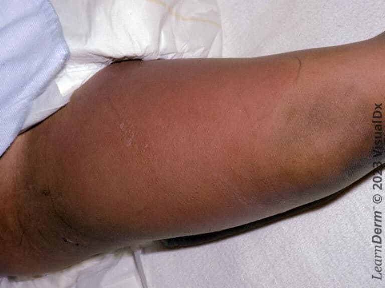 A large erythematous, edematous plaque of cellulitis on the thigh.