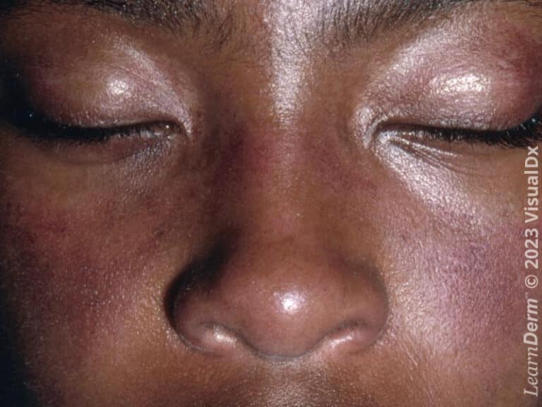 Eyelid erythema in a patient with dermatomyositis, appearing as a deep violaceous color.