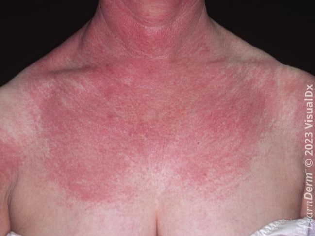 Erythema on the upper chest and neck in dermatomyositis.