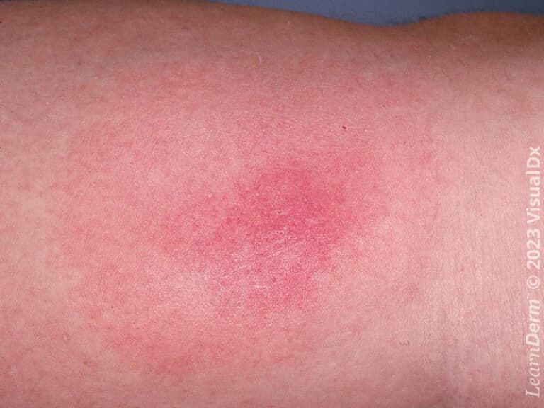 Erythematous patch in Lyme disease.